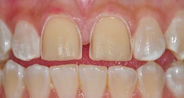 برداشتن کامپوزیت دندان از طریق پیوند دندان