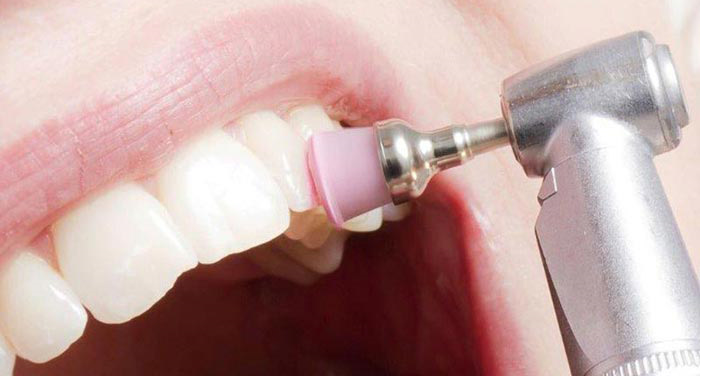 پالیش دندان یک روش کاملاً ساده است