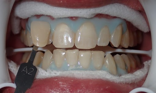 آیا تغییر رنگ دندان هایی که ناشی از مصرف دخانیات و نیکوتین است با بلیچینگ قابل درمان است؟