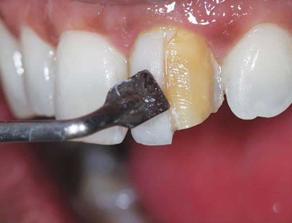 مزایای اصلی برداشتن کامپوزیت دندان