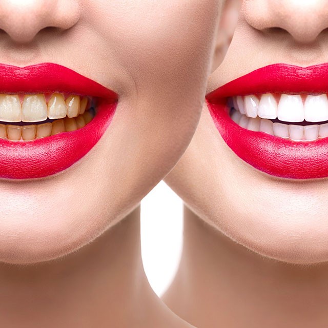 معمولا برای سفید کردن دندان ها چه روش هایی وجود دارد؟